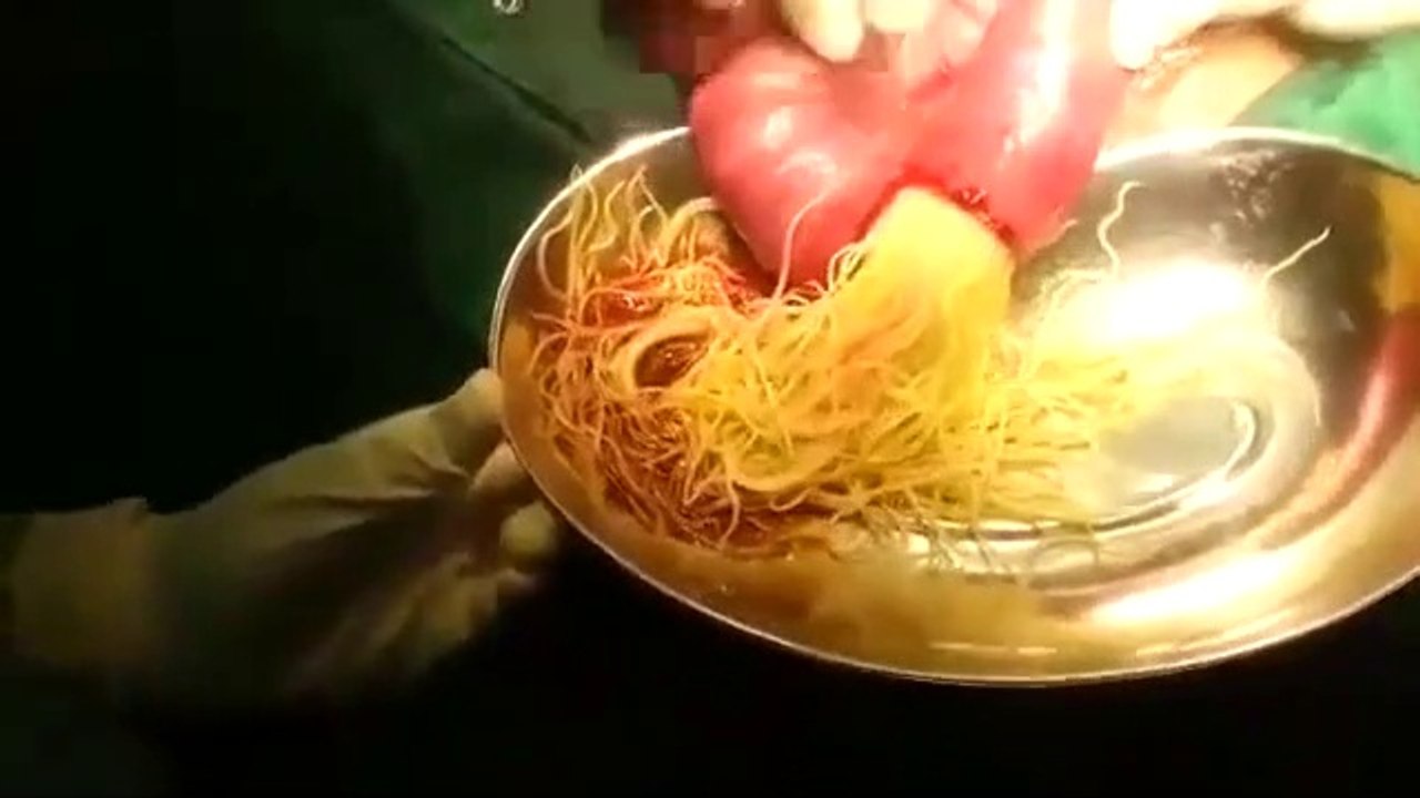 Intestinal Worms Removal ascaris worms