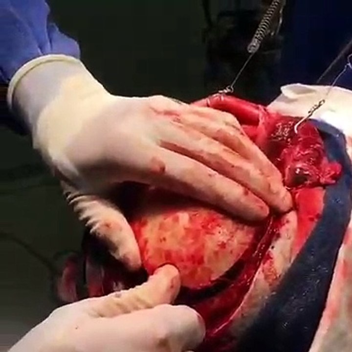 That blood clot literally covers the brain! brain stroke