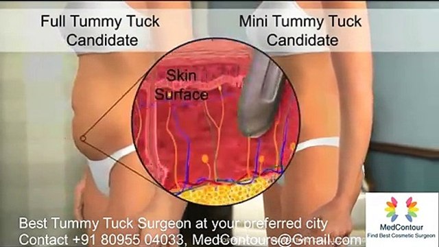 Tummy Tuck surgeon in Hyderabad. Best Tummy Tuck cost Hyderabad. Abdominoplasty surgery Hyderabad