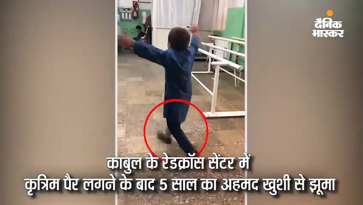 कृत्रिम पैर लगते ही 5 साल का बच्चा अस्पताल में...