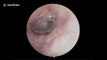 Tiny spider found building a nest in man’s ear in China in stomach-churning clip