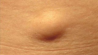 How to Know if You Have Lipoma