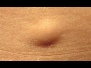 How to Know if You Have Lipoma