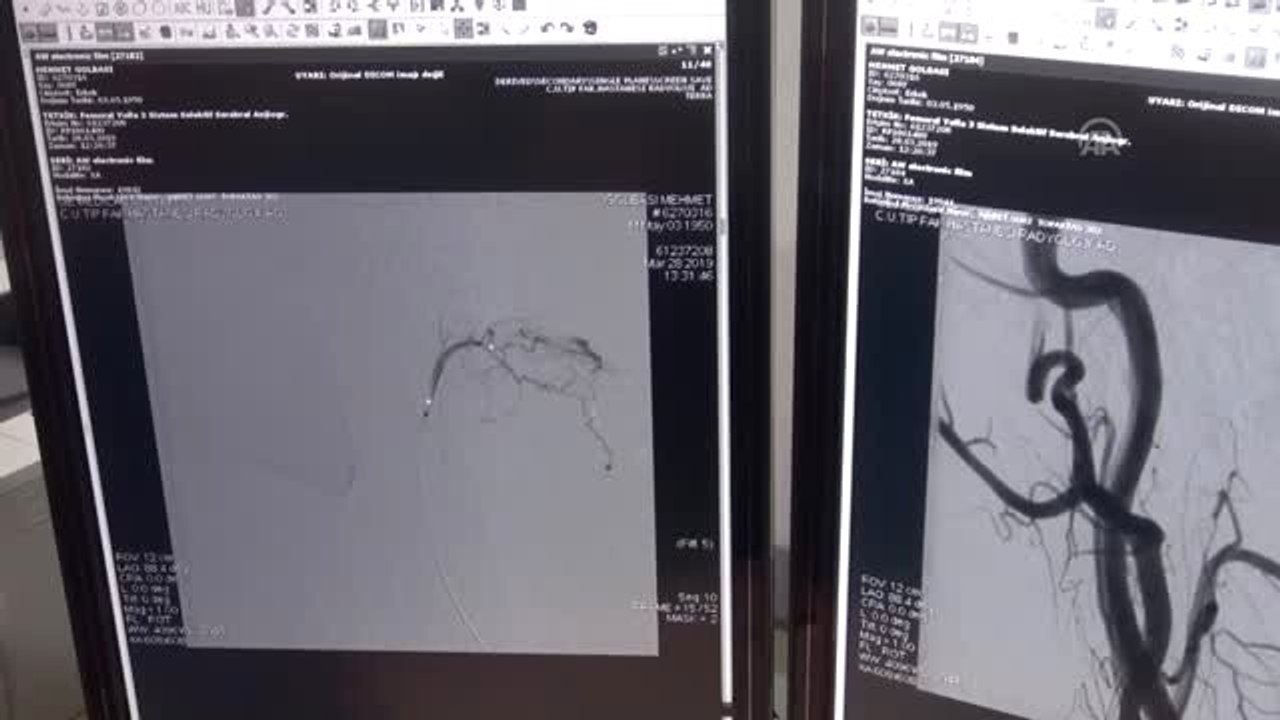 Kapalı Yöntem Beyin Ameliyatıyla Sağlığına Kavuştu