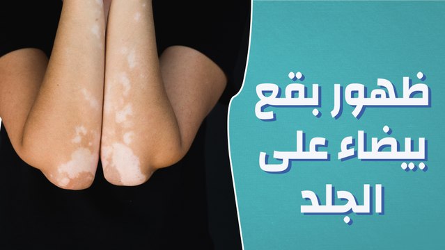 ظهور بقع بيضاء على الجلد