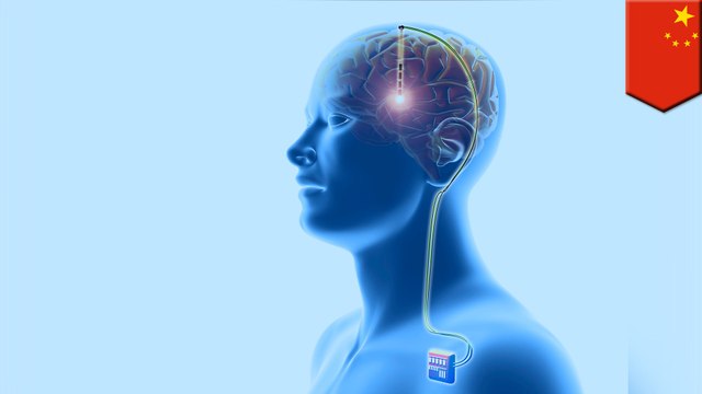 Chinese surgeons use brain implants to treat drug addiction