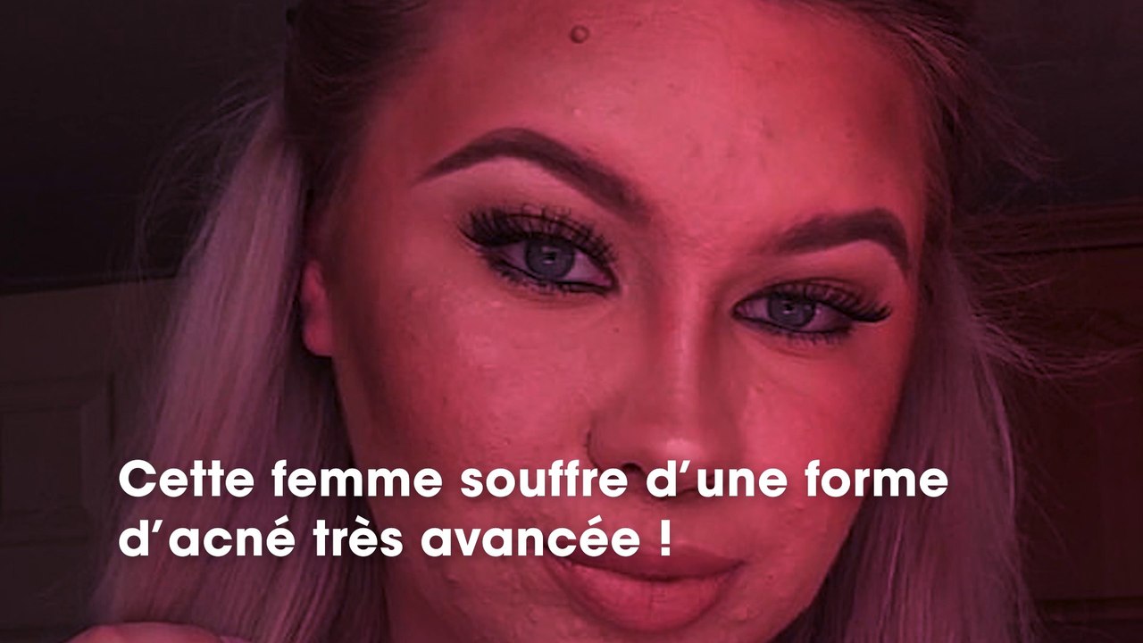 Son acné est telle sans maquillage, que cette jeune femme refuse de sortir avec un homme