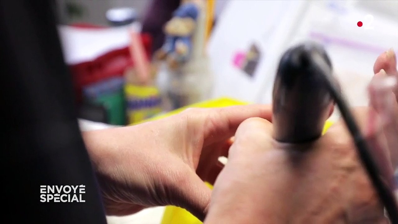 Pour reconstruire un visage mutilé, la médecine utilise des techniques dignes des effets spéciaux au cinéma