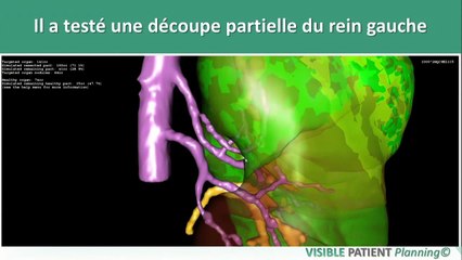Ces innovations qui font la une à VivaTech : Visible Patient, une nouvelle chirurgie guidée par l'image 3D