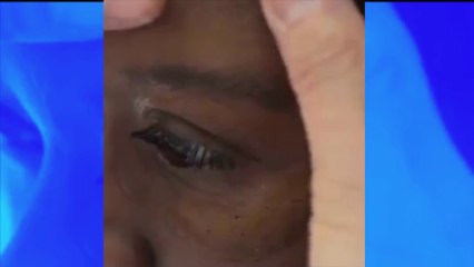 Mutilée après un cancer de l’œil, les médecins lui changent la vie, sa réaction est bouleversante