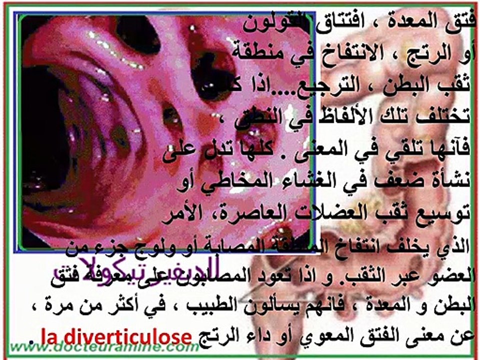 Diverticulite colique - Nouvelles recommandations médico-chirurgicales