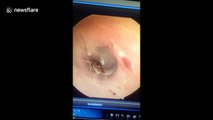 Skin-crawling moment cockroach burrows inside man's ear during removal in Vietnam