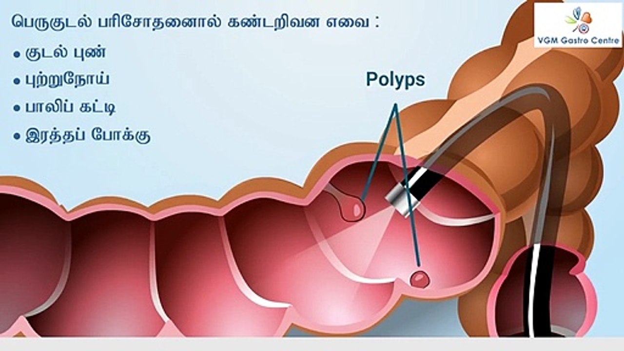 About Colonoscopy Procedure and the Importance of Preparation - VGM Gastro Centre