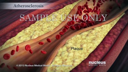 Acute_Coronary_Syndrome_and_Heart_Attack