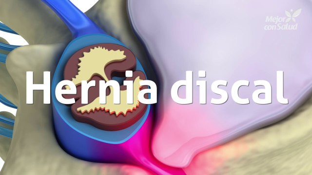 Hernia discal: síntomas y tratamiento