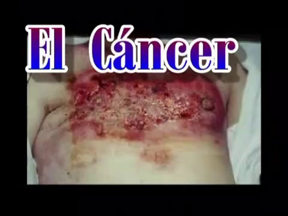 EL CANCER ES POR COMER CARNE!!-SD
