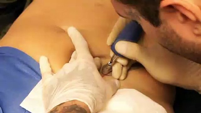 Tatuaje sobre una cicatriz - Tatto