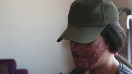 Un ataque con ácido en Turquía reabre el debate sobre la violencia machista