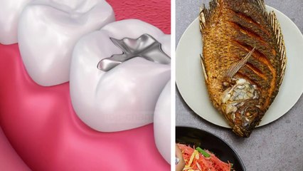 Studim: Janë vërtetë të rrezikshme mbushjet dentare me amalgamë?