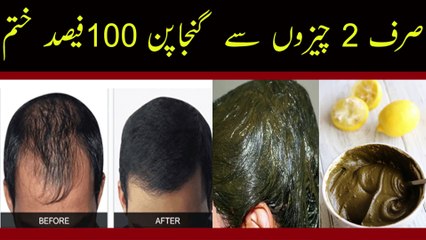 Hair Fall Treatment in Urdu || Ganjapan Ka Aasan Desi Ilaj || گنجا پن ہمیشہ کیلیئے ختم