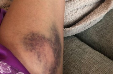 Chrissy Teigen falls down stairs