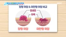 [HEALTH] Stomach cancer not found by endoscopy ?!,기분 좋은 날20190529