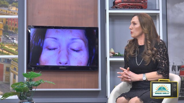 Mjekja dermatologe rrëzon mitin: Nuk shkaktohen vetëm nga dielli, bëni kujdes!!