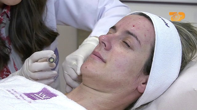 Klinika Anassa - Mezoterapia, terapia më e rekomanduar për stinën e verës E Diell , 19 maj 2019