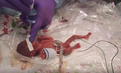 Dünyanın en küçük bebeği yaşam mücadelesini kazandı