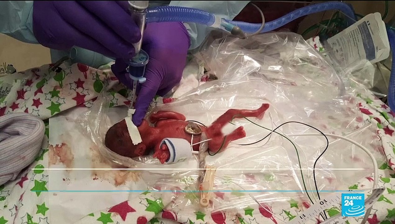 Miracle en Californie, où naît le plus petit bébé du monde