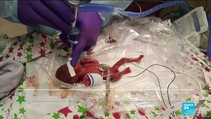 Miracle en Californie, où naît le plus petit bébé du monde
