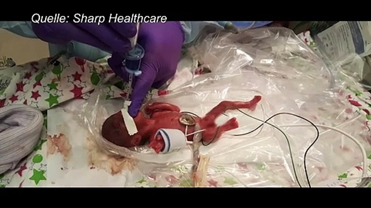 Kleinstes Frühchen der Welt kann Krankenhaus verlassen