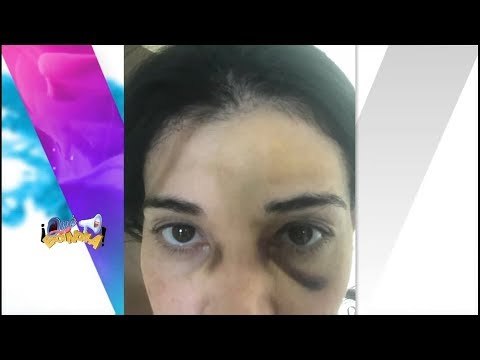 Ana Celia tiene marcas de su accidente | Vivalavi