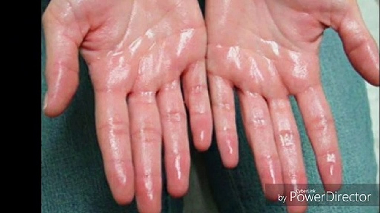 Hyperhidrosis/Sweaty hands treatment in Pakistan , No more excessive sweating