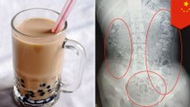 Dokter temukan ratusan butir bubble tea dalam usus gadis - TomoNews