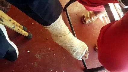 Homem quer indenização após cair em bueiro e sofrer fratura