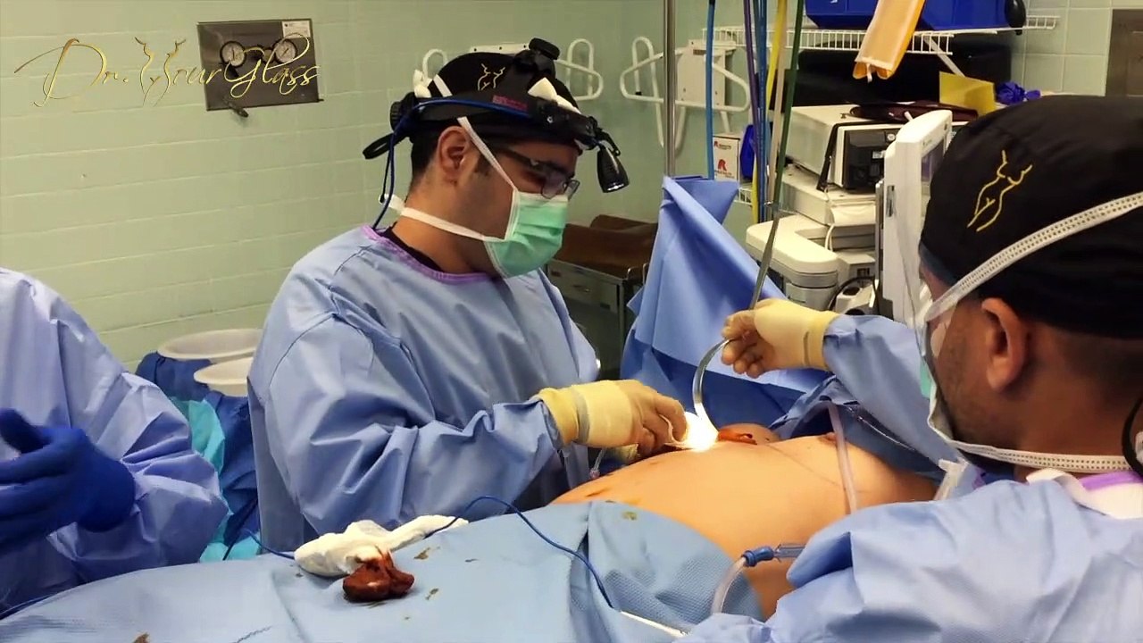 Abdominal swelling after breast augmentation