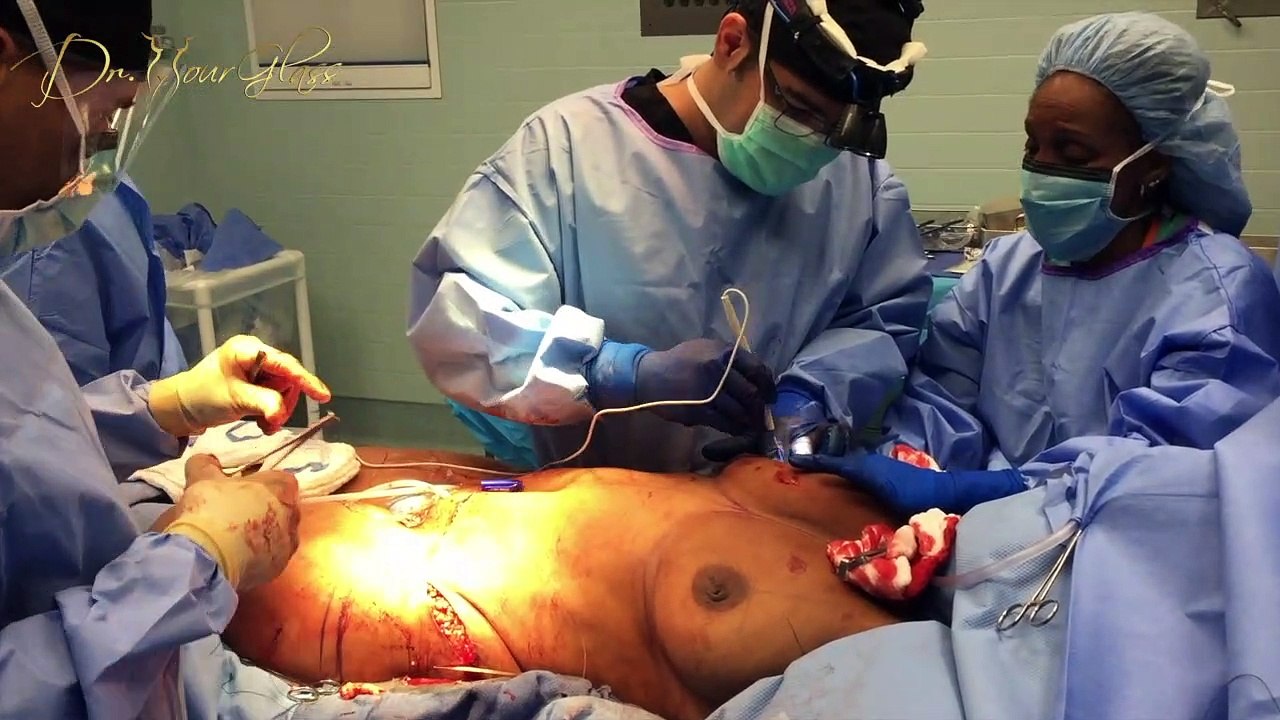 Breast reduction and stretch marks