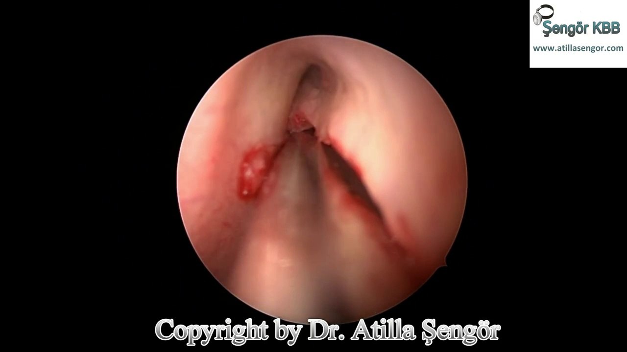 Endoskopik Konka Bülloza Ameliyatı (Shaver ile) - Endoscopic concha Bullusa Resection with Shaver
