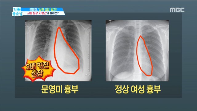 [HEALTH] Is your heart fat too? The substance of fat heart and fatty liver,기분 좋은 날20190610