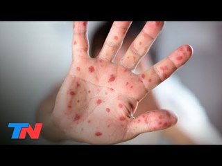 Con Bienestar: segundo caso de rubeola en dos meses