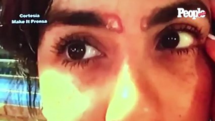 Liz Gallardo sufre daños irreversibles en su cara por mala praxis estética