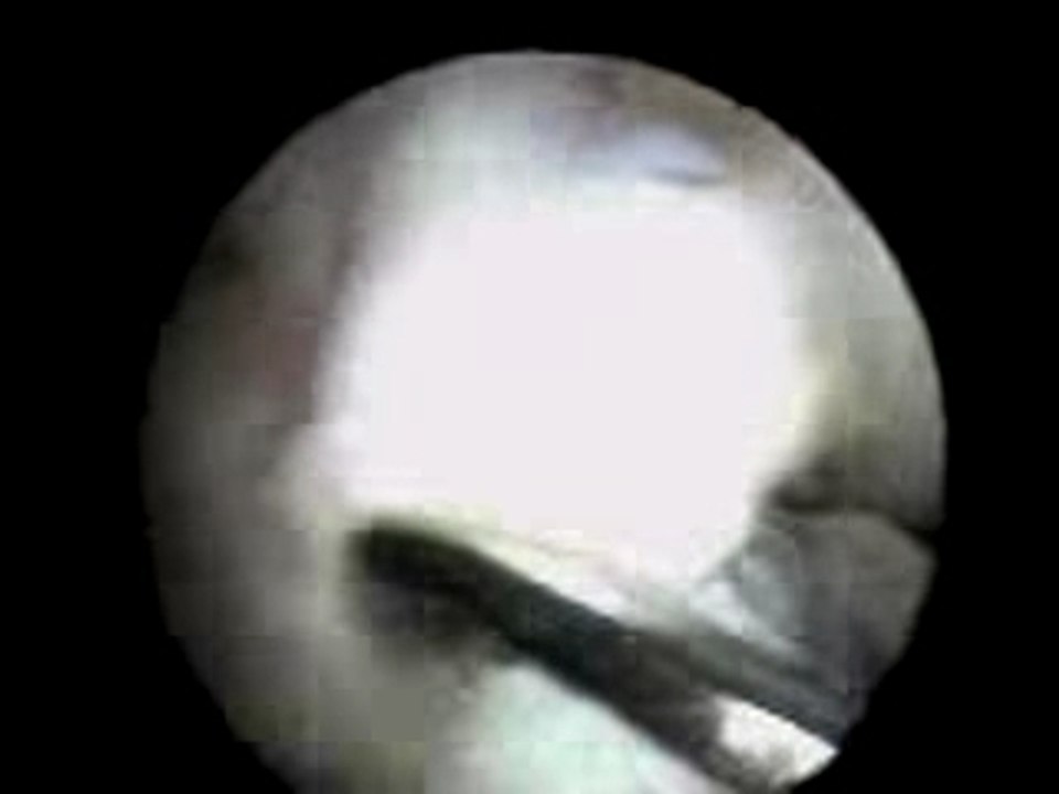 Syndrome du cyclope