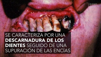 El escorbuto, enfermedad mortal del siglo XVIII, reaparece en los países desarrollados