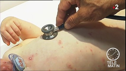 Santé : 12 régions françaises touchées par la varicelle