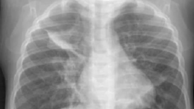 Congeló sus pulmones llenos de amianto