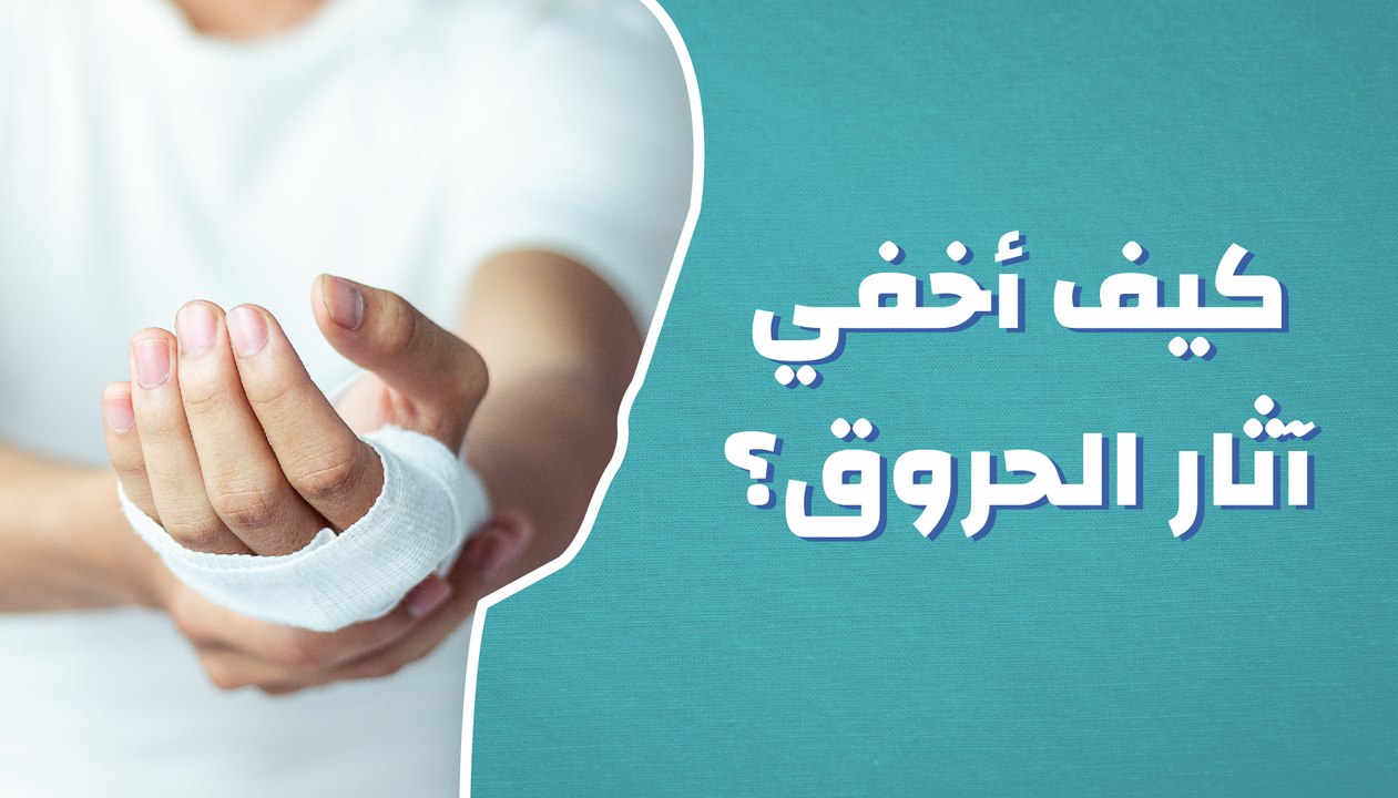 كيف أخفي آثار الحروق؟