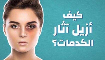 كيف أزيل آثار الكدمات؟