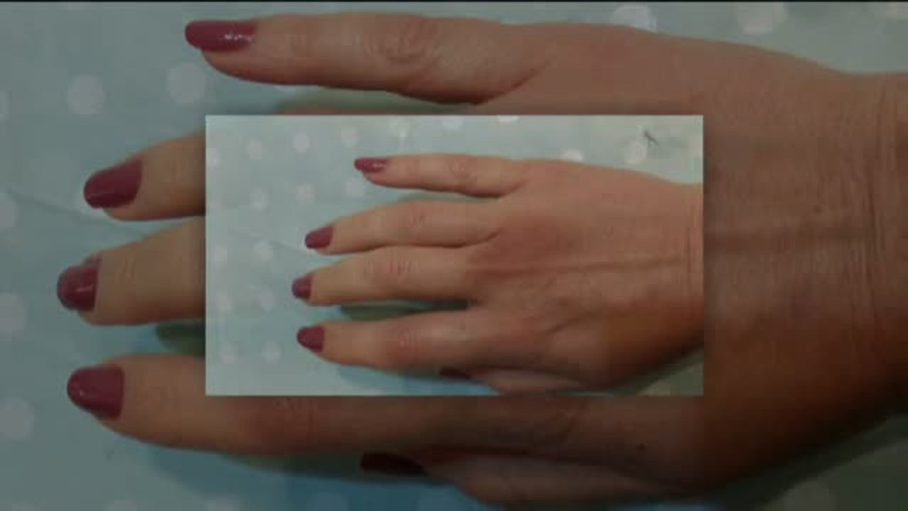 Cientos de mujeres siguen luchando para que se reparen los daños que, aseguran, les provocó el anticonceptivo Essure