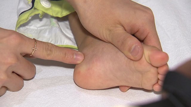 때 이른 더위에 '수족구병' 급증...손씻기 등 주의 필요 / YTN